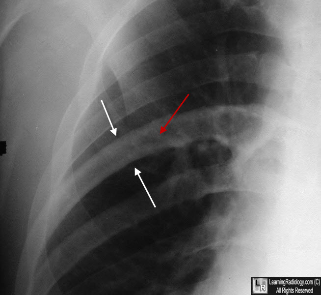 Paget Disease, right 6th rib